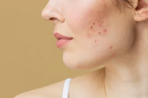 Collagen Peptides Cause Acne